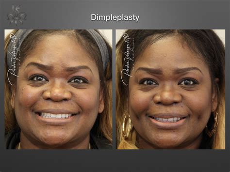 plastic surgery for dimples